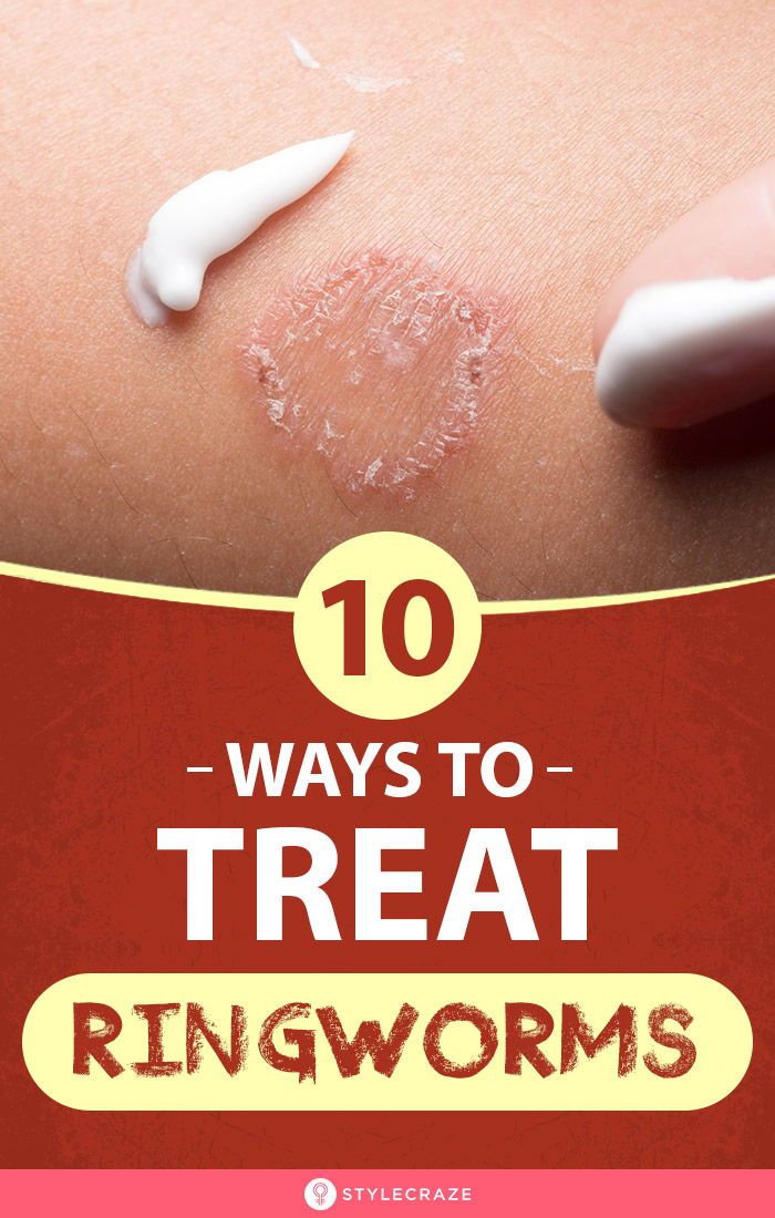 How To Treat Ringworm