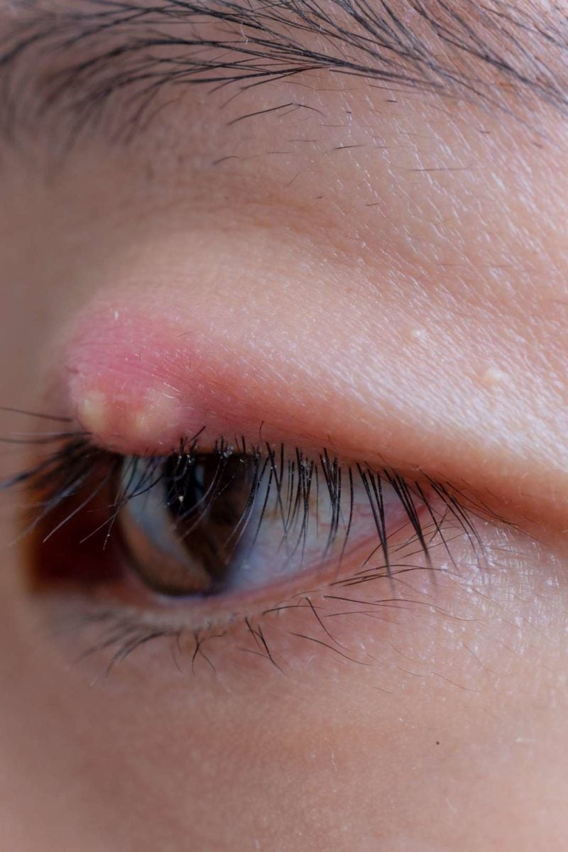 How To Treat A Stye