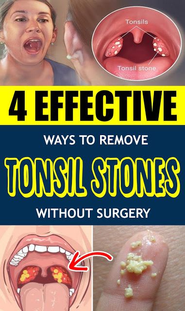 How To Prevent Tonsil Stones