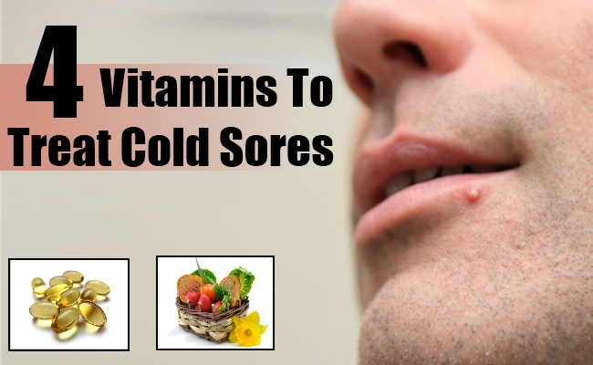 How To Treat Cold Sores