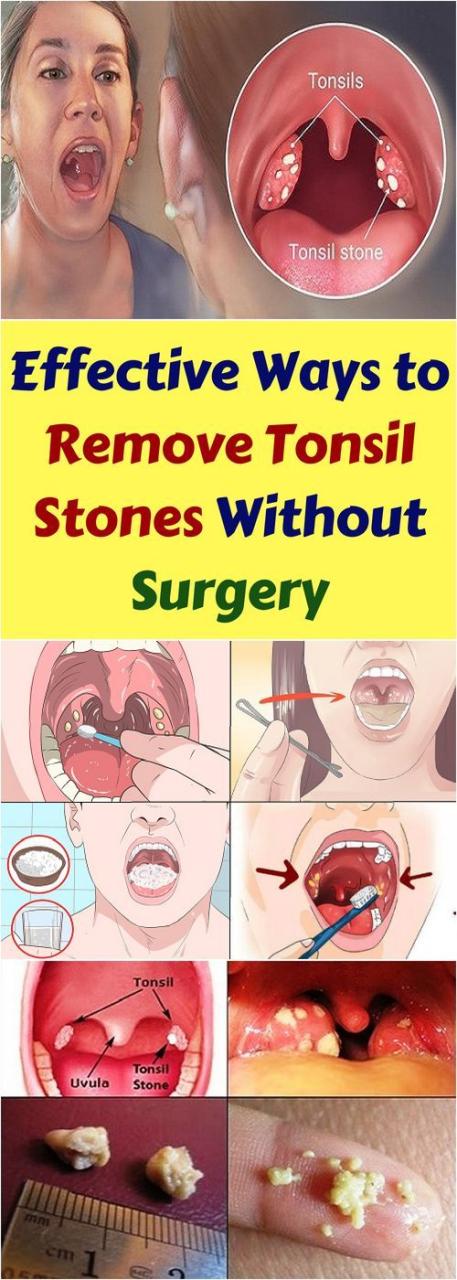 How To Remove Tonsil Stones