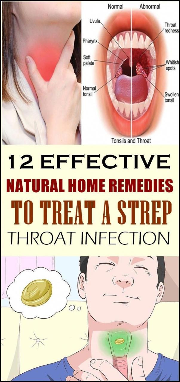 How To Treat Strep Throat