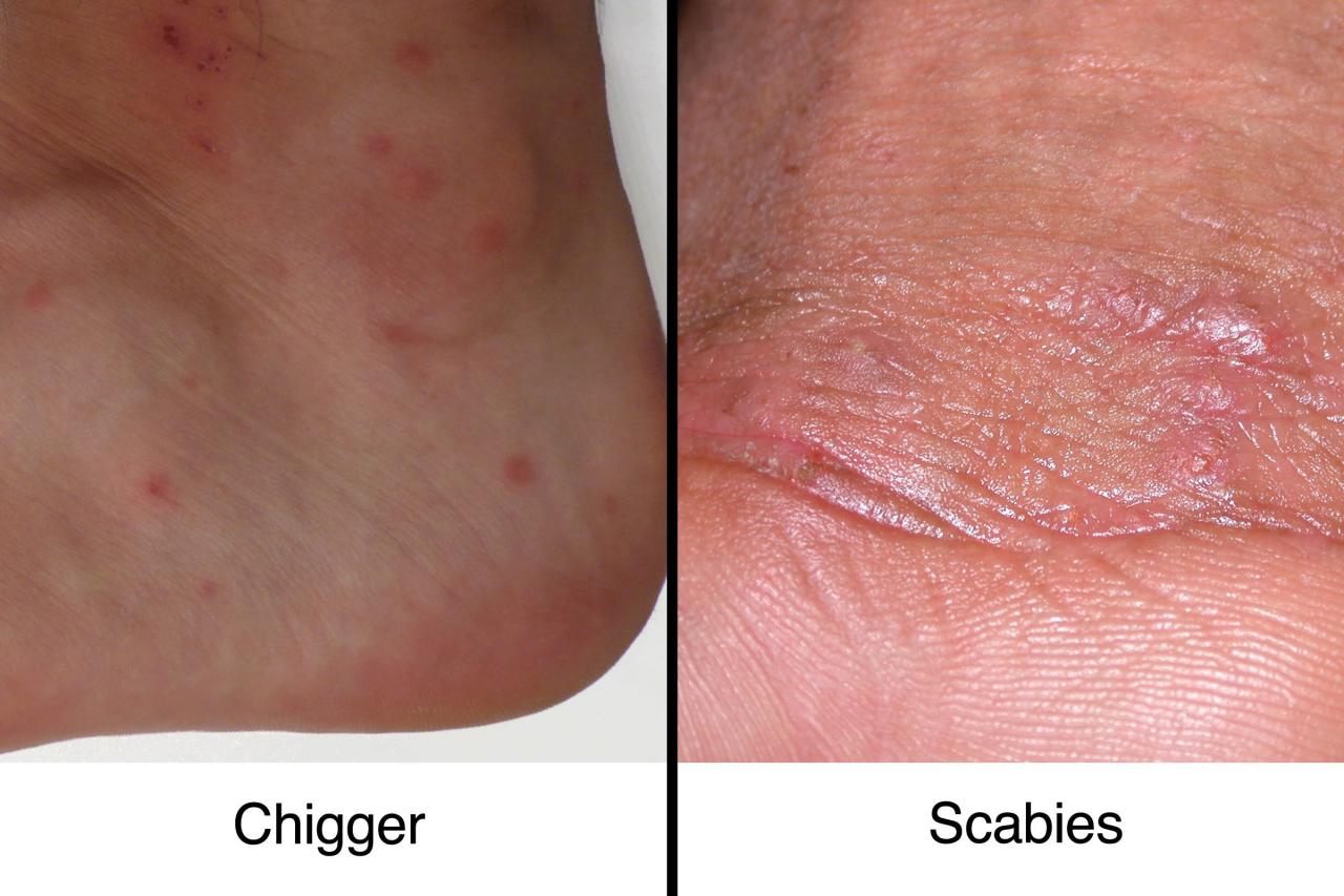 How To Identify Scabies