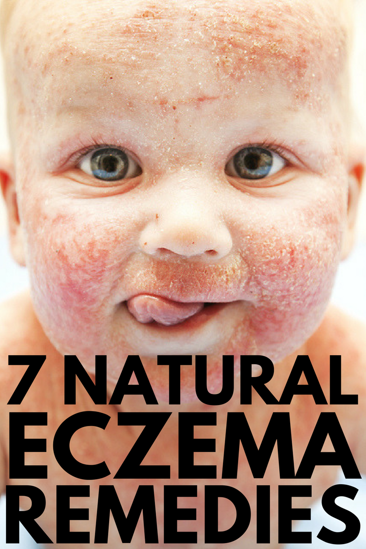 How To Treat Eczema