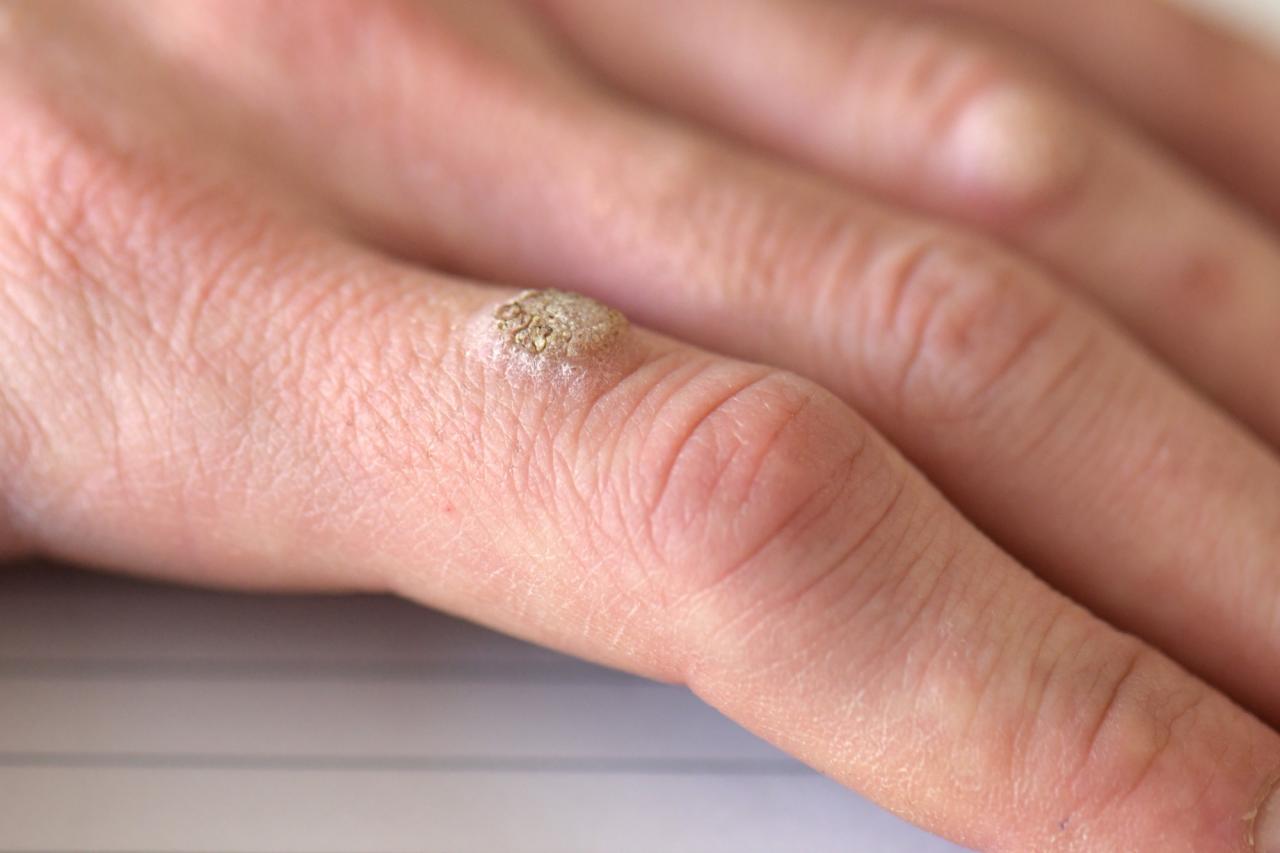 How To Identify A Wart