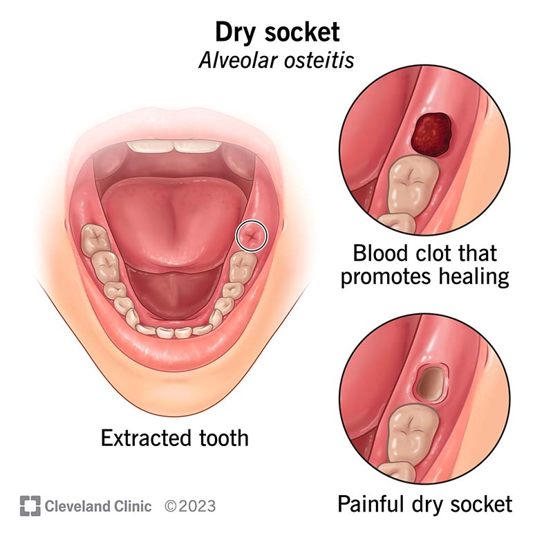 How To Prevent Dry Socket