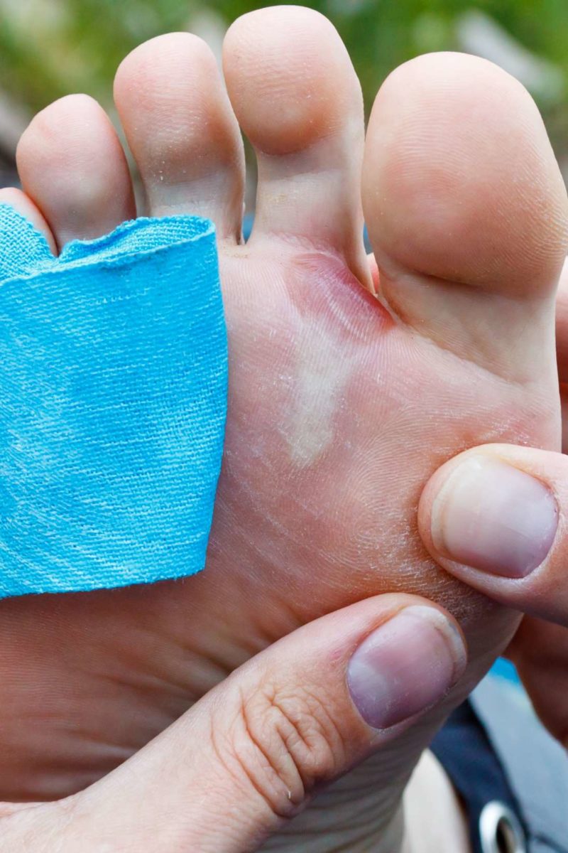 How To Treat A Blister