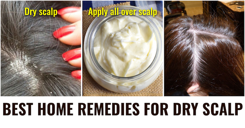 How To Treat Dry Scalp