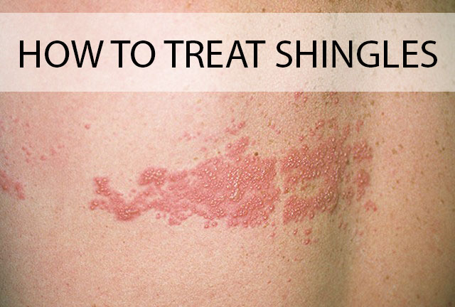 How To Treat Shingles