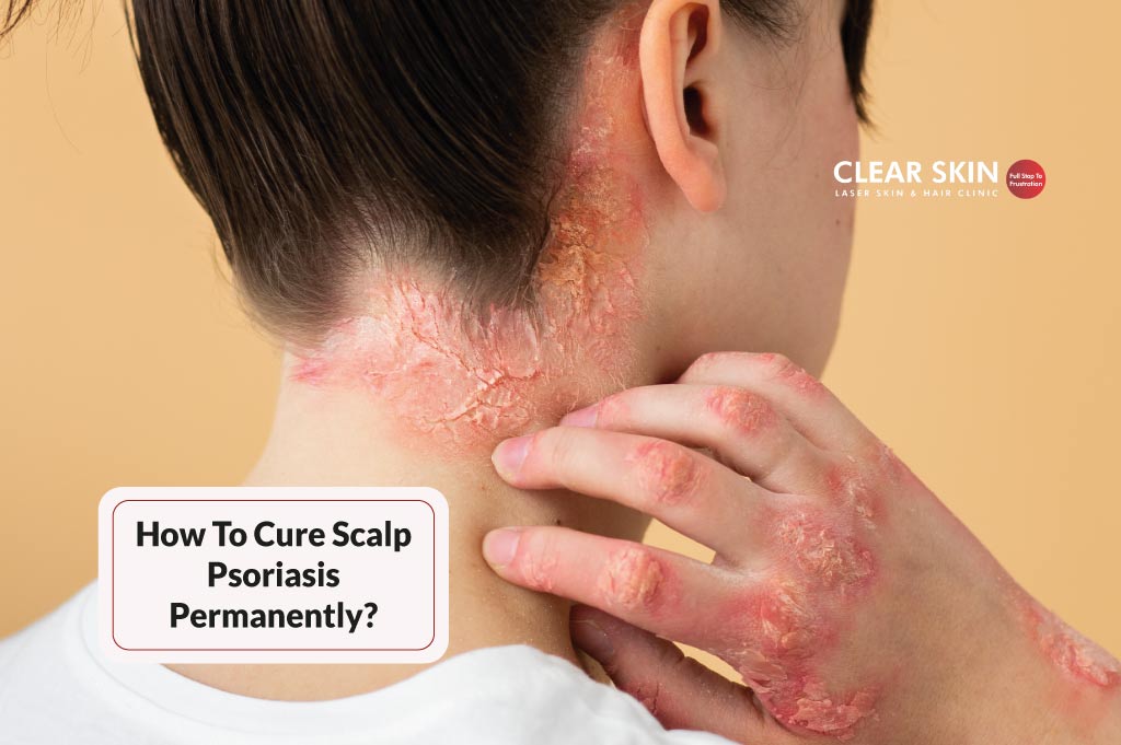 How To Cure Psoriasis Permanently