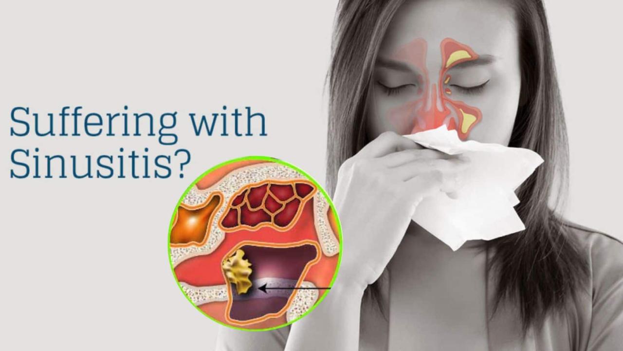 How To Cure Sinus Permanently