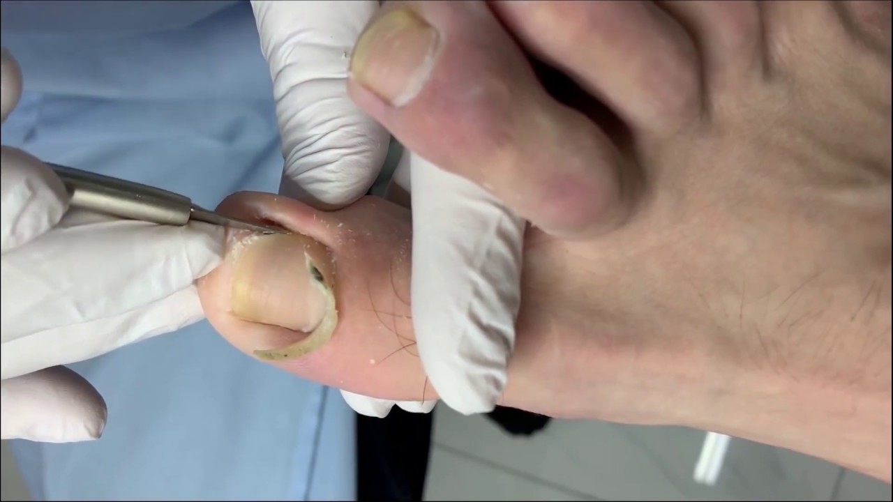 How To Remove Ingrown Toenail