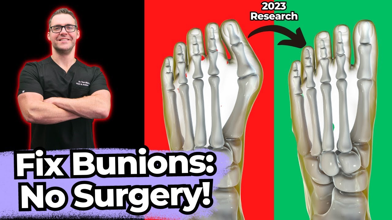 How To Shrink Bunions Naturally