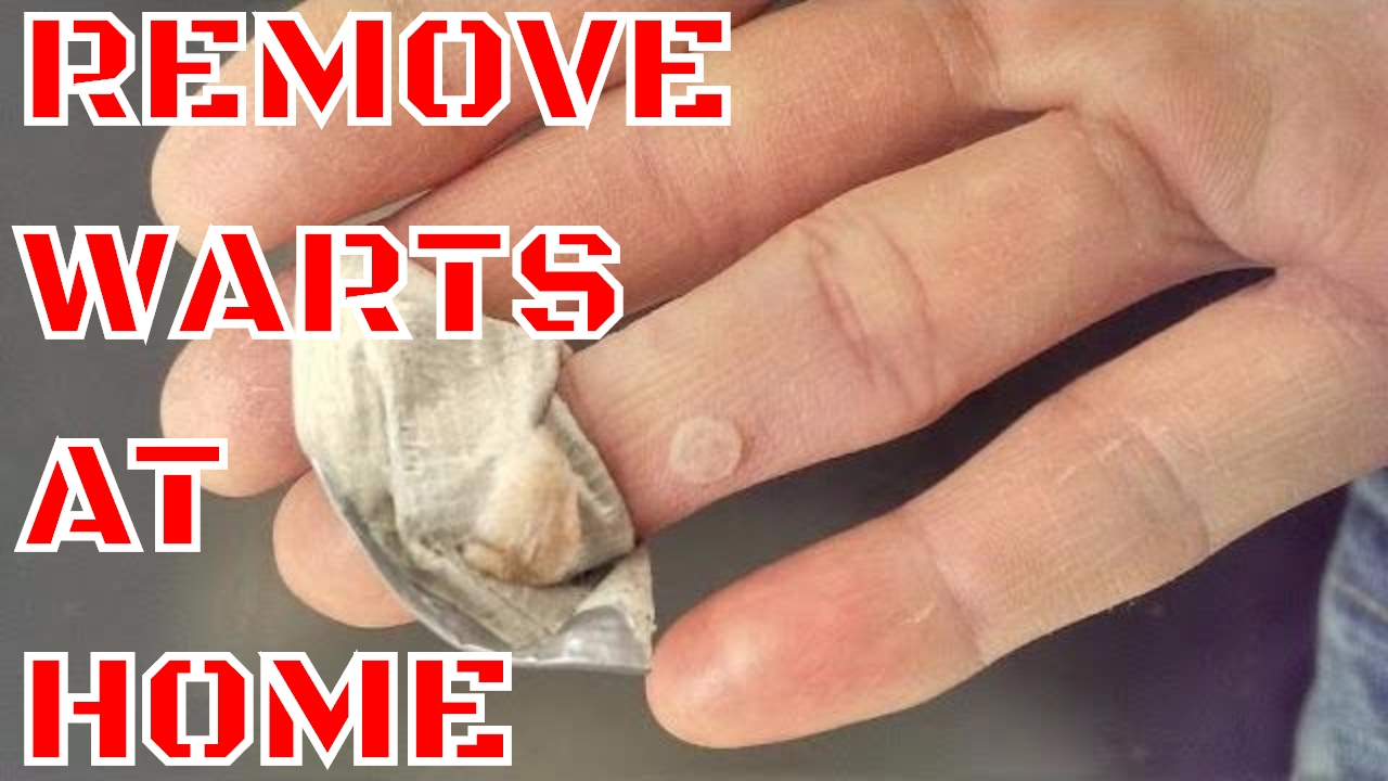 How To Remove Warts