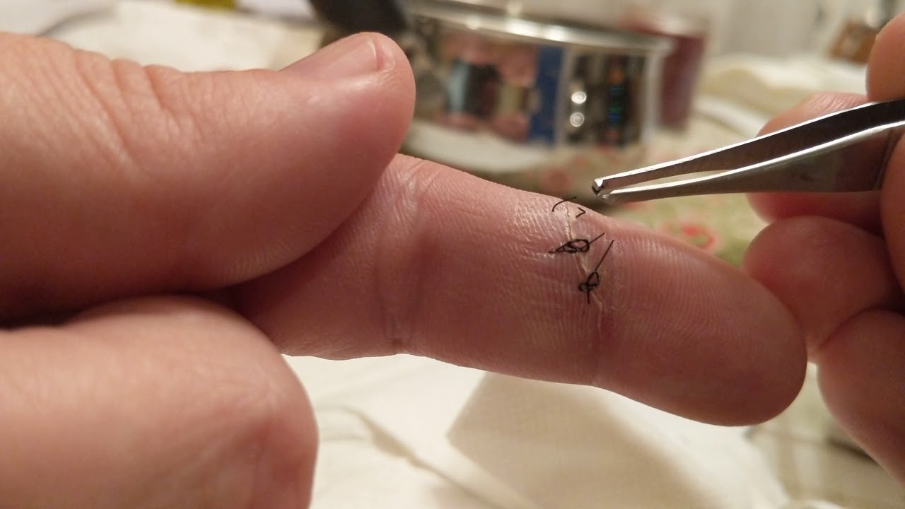 How To Remove Stitches