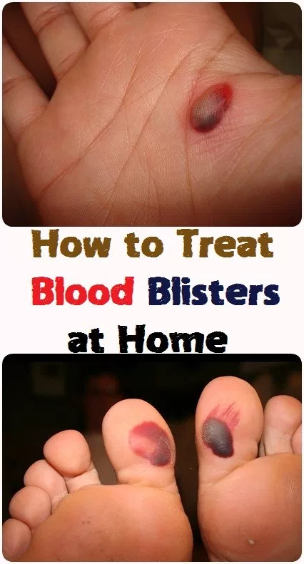 How To Treat Blisters